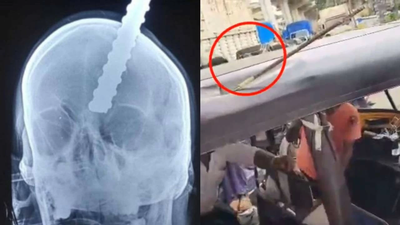 X-ray of the man who suffered critical injuries when a metal rod fell from an under-construction metro site, piercing his head.