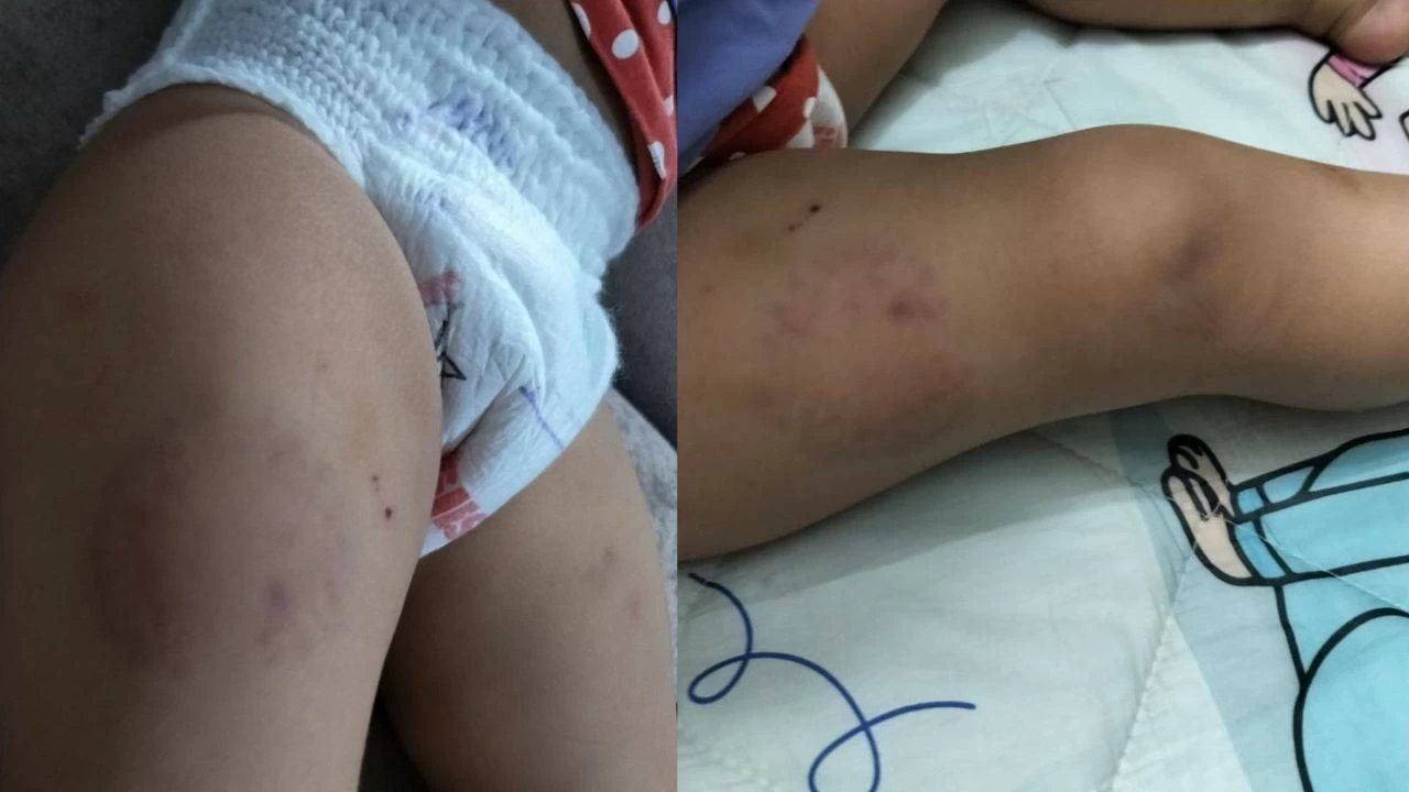 A combination of images show the injuries that the 15-month-old suffered after being bitten at the day-care centre 