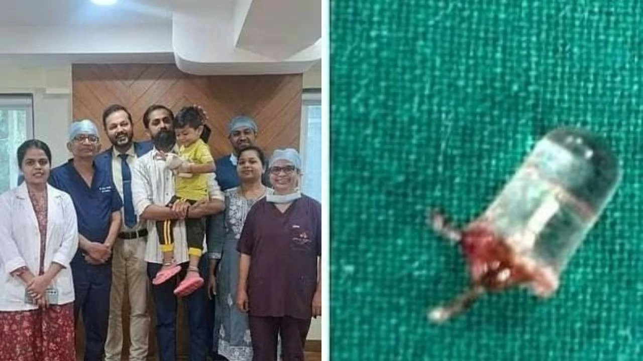 Kolhapur toddler recovers after tiny toy bulb is safely removed from his lung.