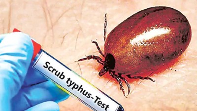 Scrub Typhus representational picture. 