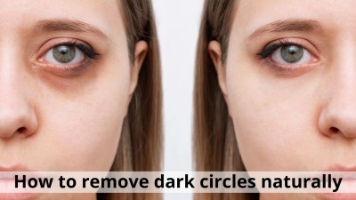 Struggling with dark circles? Natural home remedies that guarantee long-term benefits 
